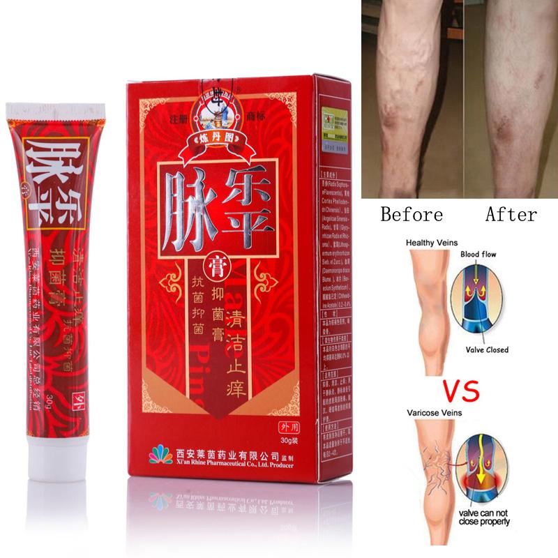 Varicose Veins Treatment  Cream